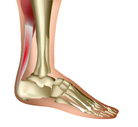 A Condition Characterized by Pain and Swelling of the Achilles Tendon, Often Resulting from Overuse and Degenerative Changes