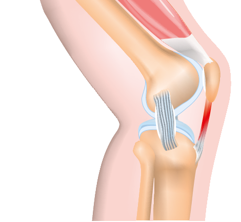 Medical illustration of Patellar Tendinopathy, a pathological state involving degeneration and irritation of the patellar tendon, resulting in anterior knee pain.