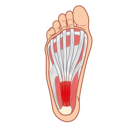 Illustration of Peroneal Tendinopathy, a pathological condition involving degeneration and irritation of the peroneal tendons, resulting in pain and instability around the outside of the ankle