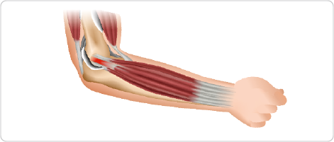 Medical illustration depicting tennis elbow, focusing on inflammation and degeneration of the forearms extensor tendons near the lateral epicondyle