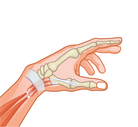 Medical illustration of De Quervains tenosynovitis, highlighting inflammation and thickening of the tendon sheaths surrounding the abductor pollicis longus and extensor pollicis brevis tendons near the base of the thumb
