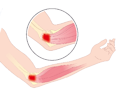 Medical illustration showing golfers elbow, emphasizing inflammation and degeneration of the forearms flexor tendons near the medial epicondyle