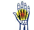 A medical illustration of wrist and fingers tendinopathy, highlighting inflammation and degeneration in the tendons, which can cause pain and affect mobility.